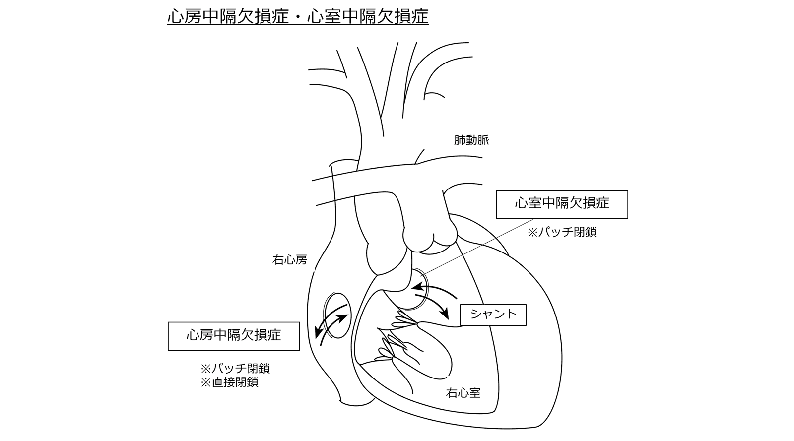 心房中隔欠損症・心室中隔欠損症