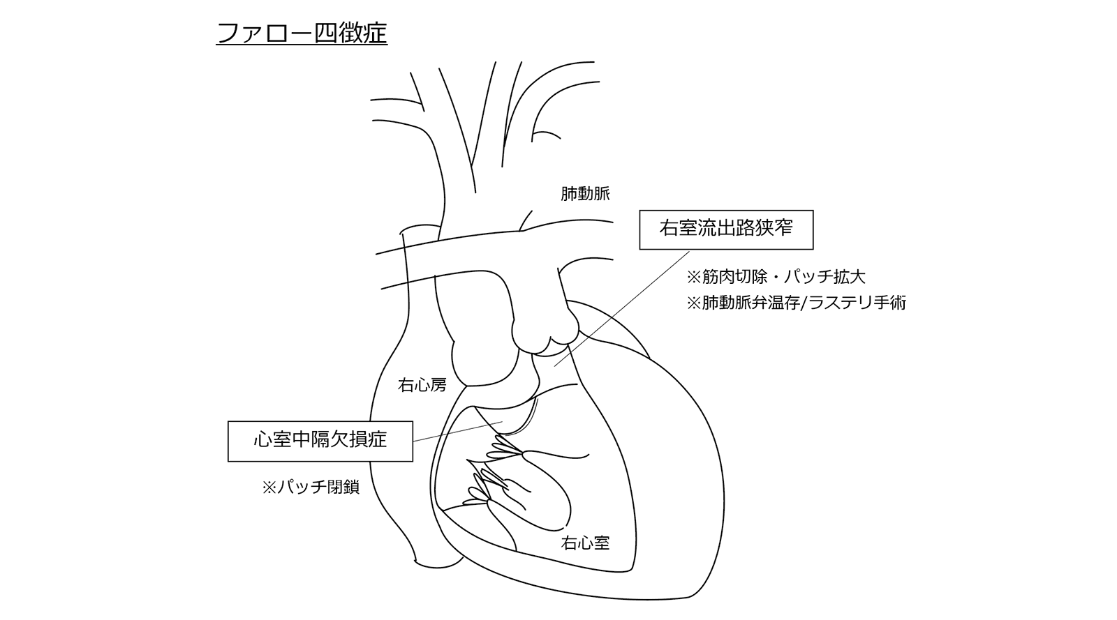 ファロー四徴症