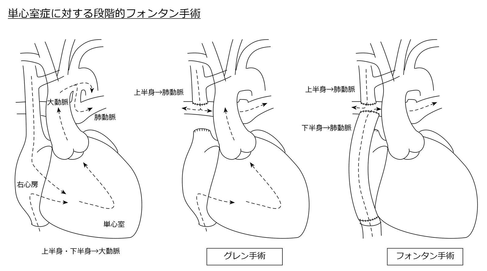 単心室症に対する段階的フォンタン手術