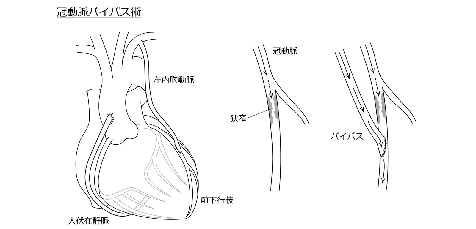 冠動脈バイパス術