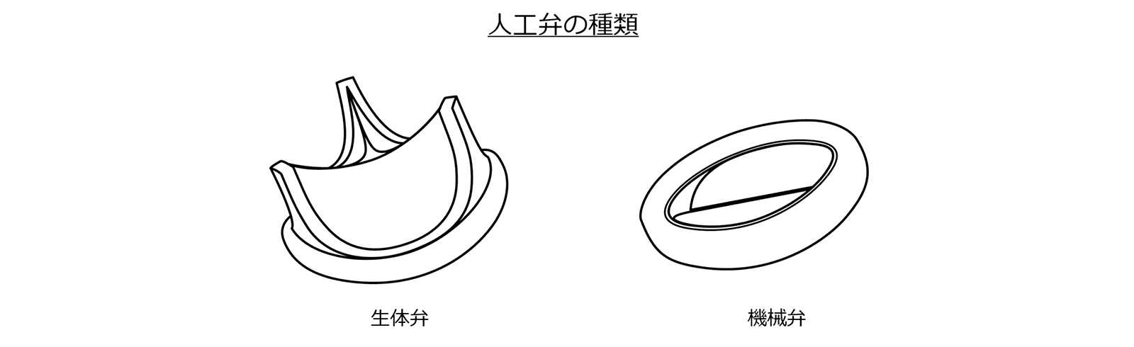 僧帽弁形成術