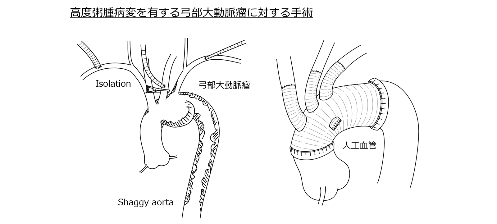 高度粥腫病変に有する弓部大動脈瘤に対する手術