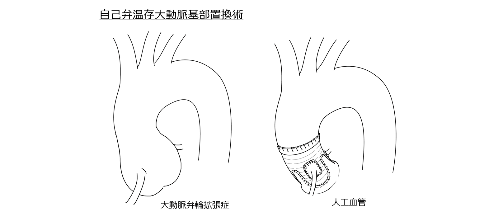 自己弁温存大動脈基部置換術