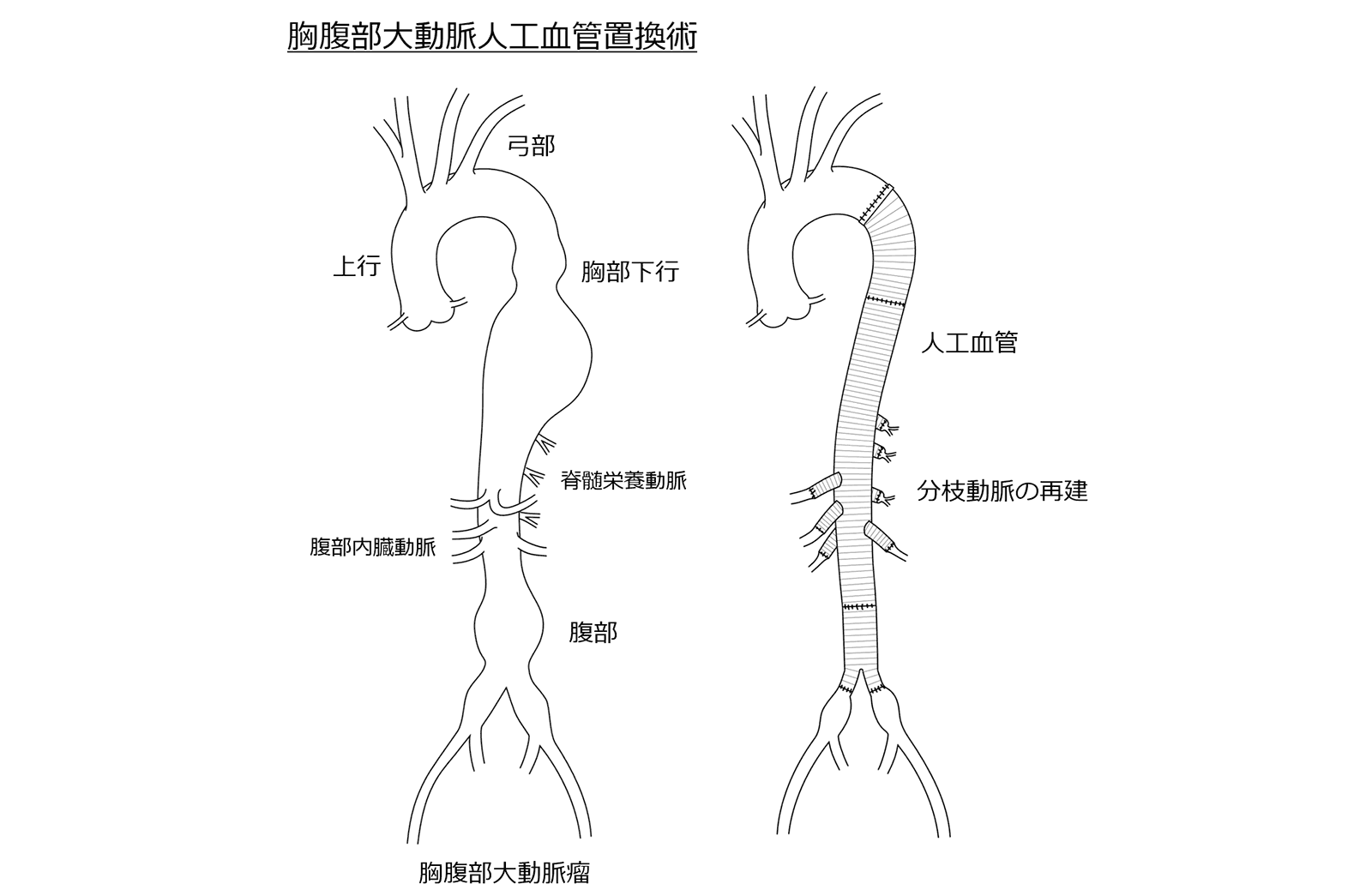 胸腹部大動脈人工血管置換術