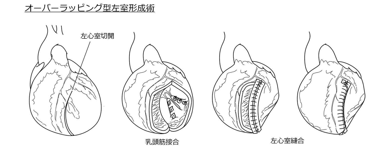 オーバーラッピング型左心室形成術