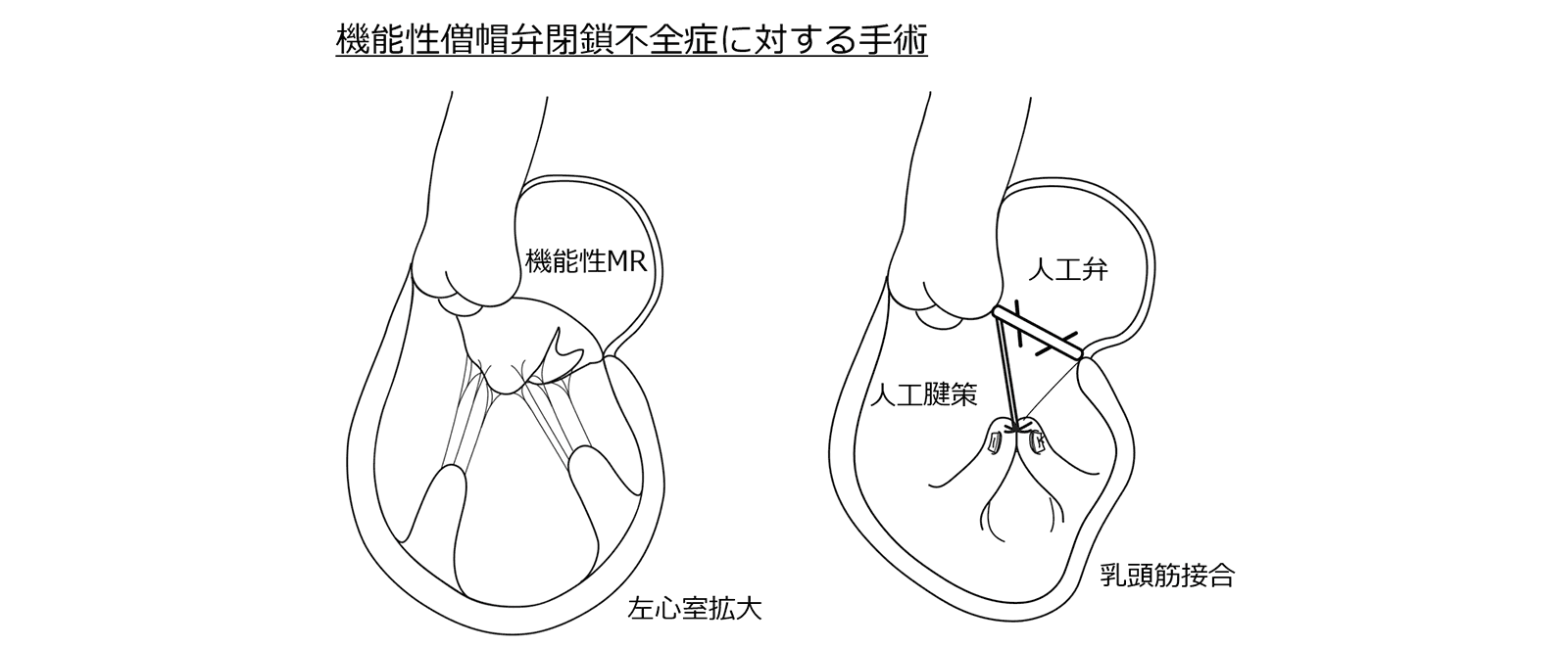 機能性僧帽弁閉鎖不全症に対する手術
